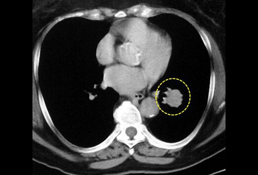 Colon cancer kras wild type anti most cancers basis