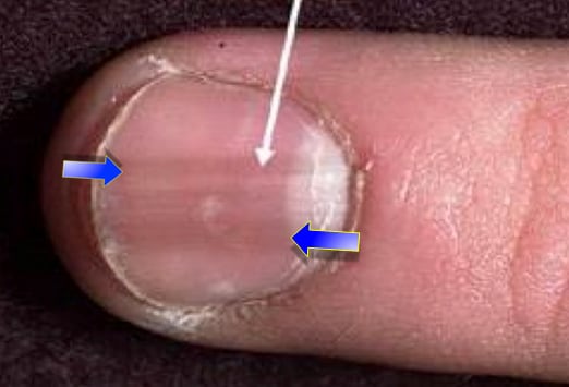 melanoma under fingernail #11