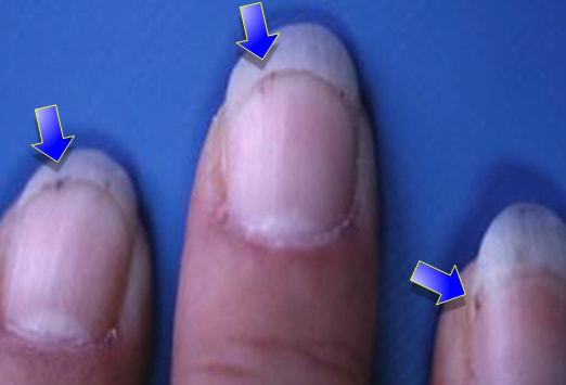 Que lon ne peut pas manger au psoriasis sur le corps